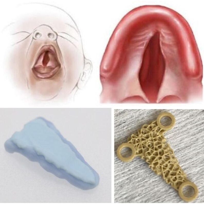 Agensmed Palatal Cleft Implant